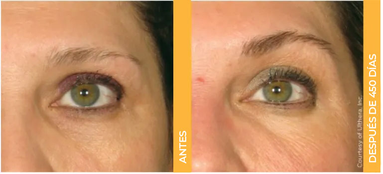 Primer plano de antes y después de las cejas de una paciente real de Ultherapy<sup>&reg;</sup>, con resultados de lifting a los 450 días.