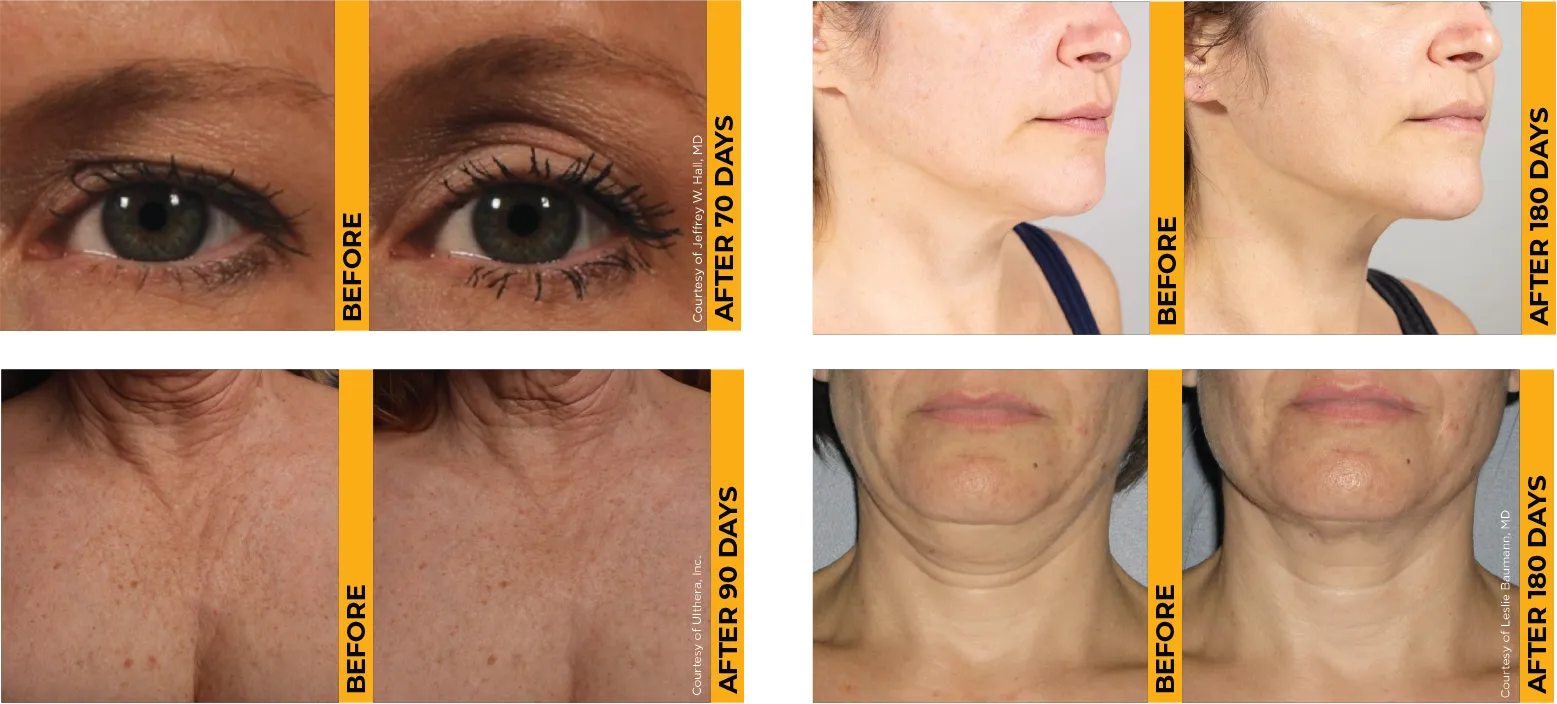 Cuatro fotos de antes y después que muestran resultados comprobados de lifting de piel en cejas, mentón, escote y cuello.