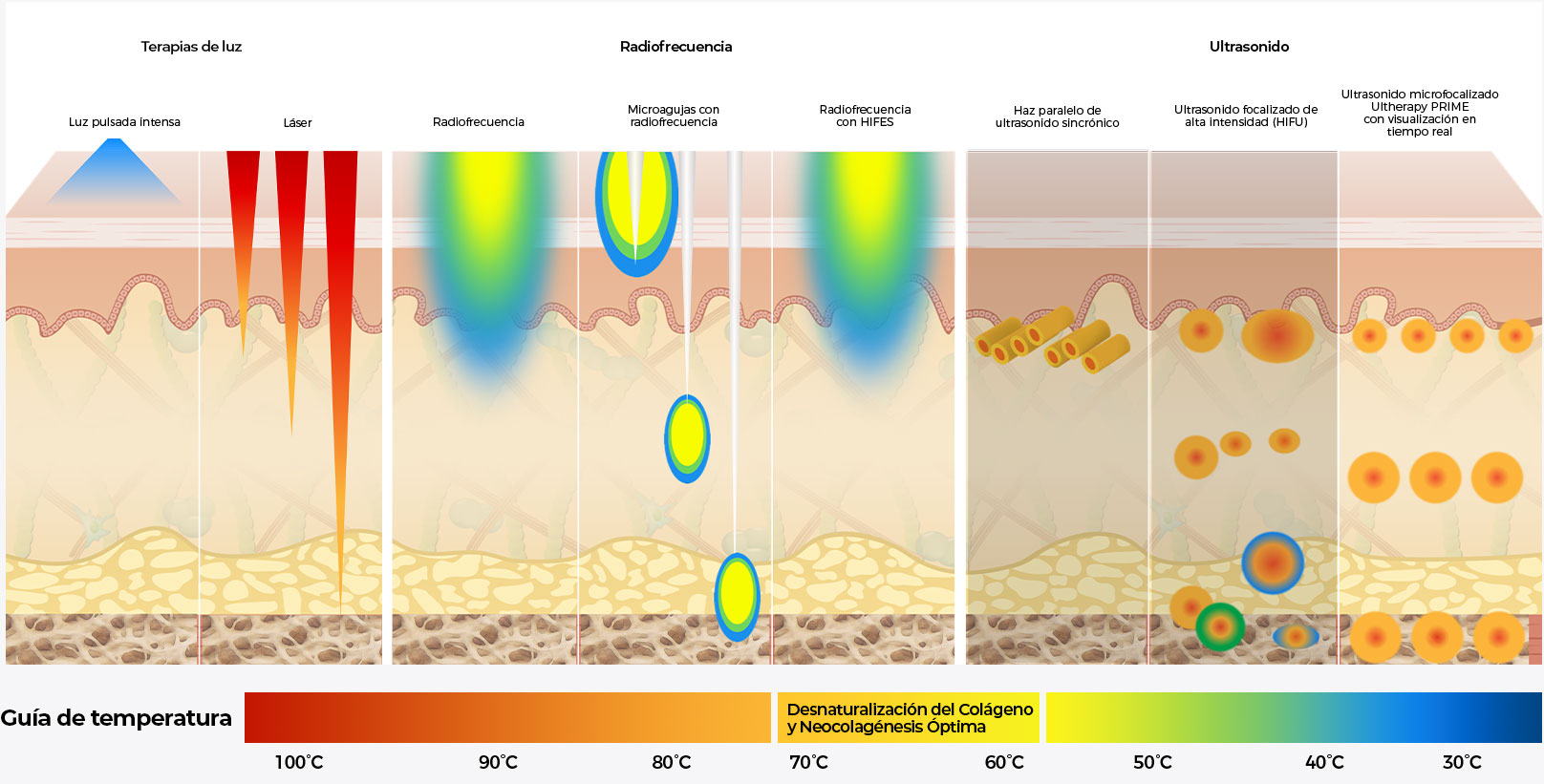 Diagrama que compara la profundidad de Ultherapy<sup>&reg;</sup> con la luz, la radiofrecuencia y otros tratamientos de ultrasonido en las distintas capas de la piel.