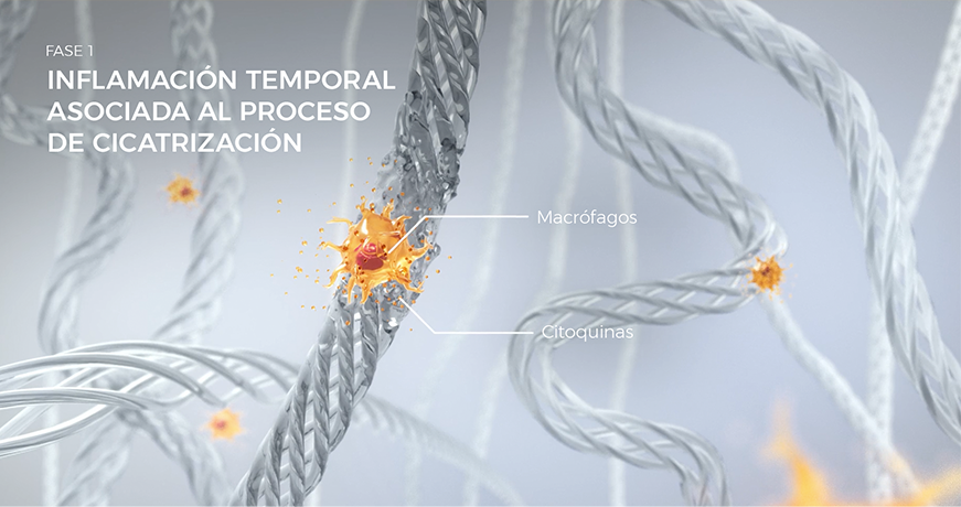 Visualización de los macrófagos durante la Fase 1 de curación, con inflamación temporal y reparación de tejido.