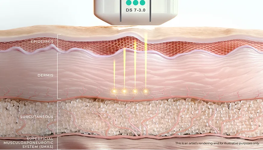 Diagrama de Ultherapy PRIME® que muestra cómo el ultrasonido microfocalizado genera puntos de coagulación térmica a profundidades precisas de la piel.