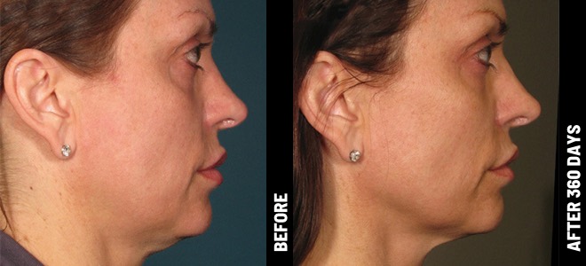 Imágenes de antes y después, una al lado de la otra, que muestran resultados de lifting y tensión de piel post-Ultherapy. Diana, 62