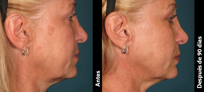 Imágenes de antes y después, una al lado de la otra, que muestran resultados de lifting y tensión de piel post-Ultherapy. 