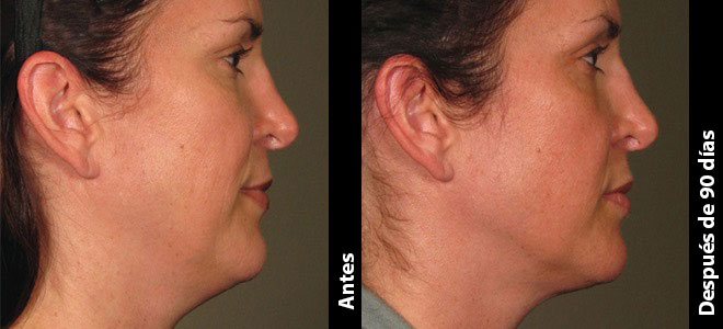 Imágenes de antes y después, una al lado de la otra, que muestran resultados de lifting y tensión de piel post-Ultherapy. 