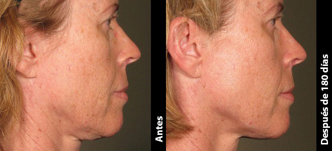 Imágenes de antes y después, una al lado de la otra, que muestran resultados de lifting y tensión de piel post-Ultherapy. 