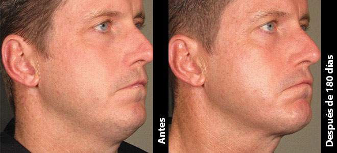 Imágenes de antes y después, una al lado de la otra, que muestran resultados de lifting y tensión de piel post-Ultherapy. 