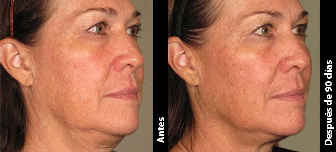 Imágenes de antes y después, una al lado de la otra, que muestran resultados de lifting y tensión de piel post-Ultherapy. 