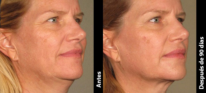 Imágenes de antes y después, una al lado de la otra, que muestran resultados de lifting y tensión de piel post-Ultherapy. 