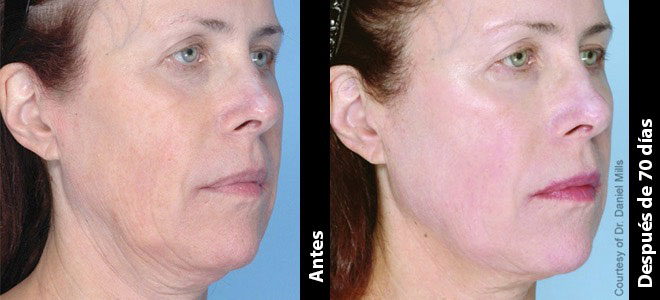 Imágenes de antes y después, una al lado de la otra, que muestran resultados de lifting y tensión de piel post-Ultherapy. 