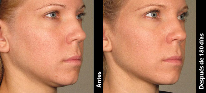 Imágenes de antes y después, una al lado de la otra, que muestran resultados de lifting y tensión de piel post-Ultherapy. 