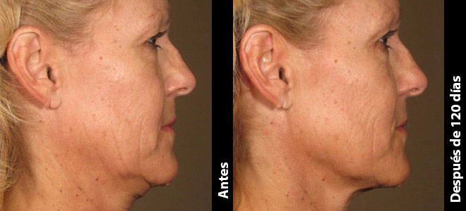Imágenes de antes y después, una al lado de la otra, que muestran resultados de lifting y tensión de piel post-Ultherapy. 