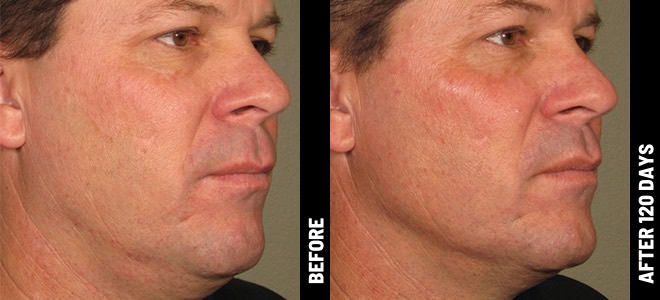 Imágenes de antes y después, una al lado de la otra, que muestran resultados de lifting y tensión de piel post-Ultherapy. 